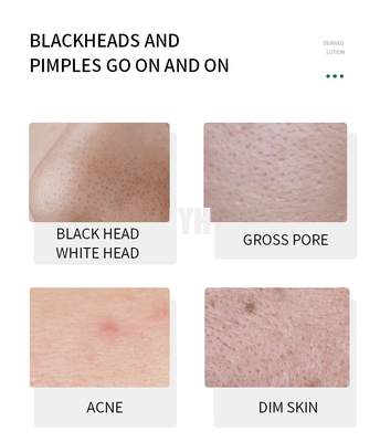 เซรั่มบำรุงผิวหน้า Lakhead Derived Essence Face Serum เซรั่มขจัดสิวหัวดำ